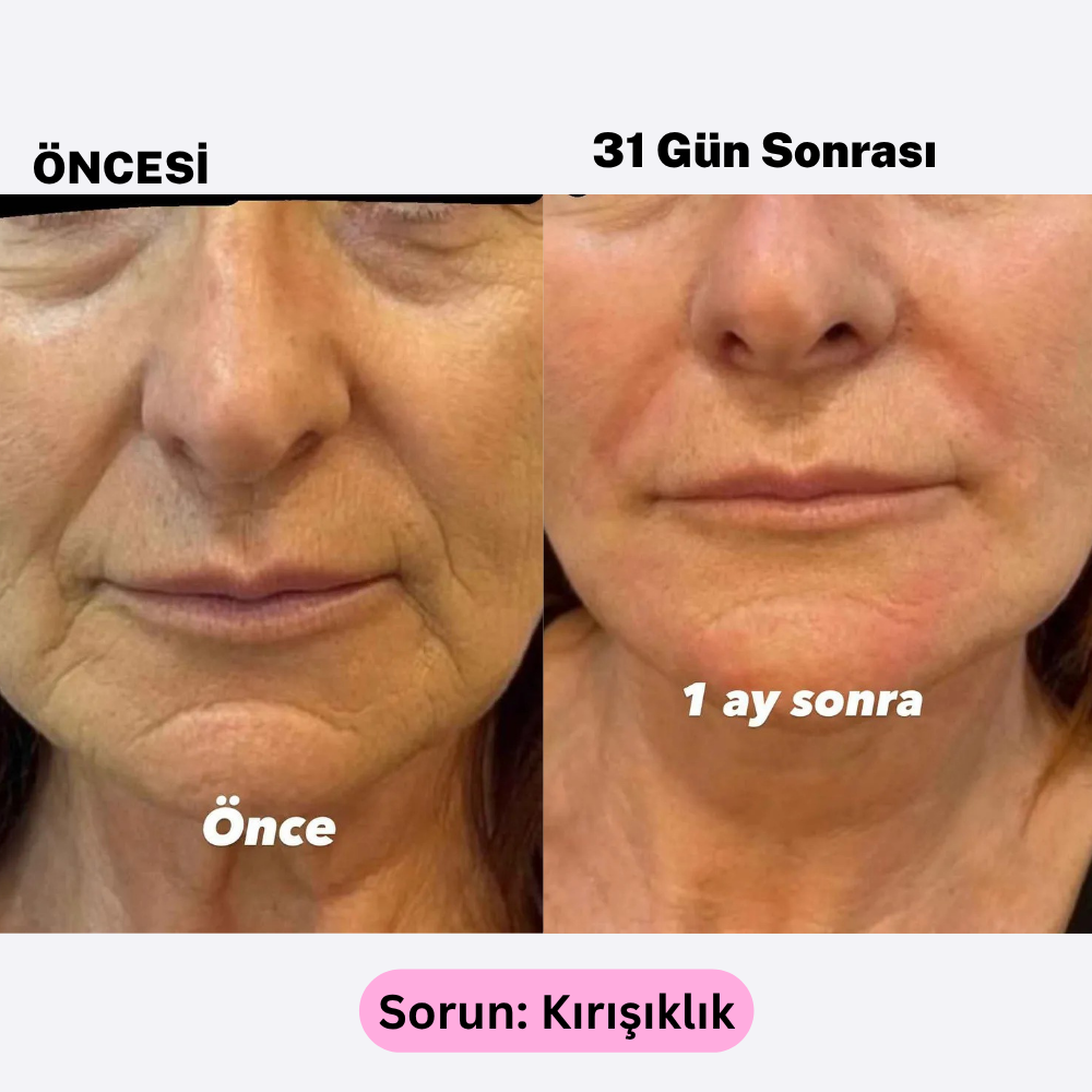 Yüz Kası Uyandırıcı EMS Cihazı | Doğal Gıdık ve Kırışıklık Giderici